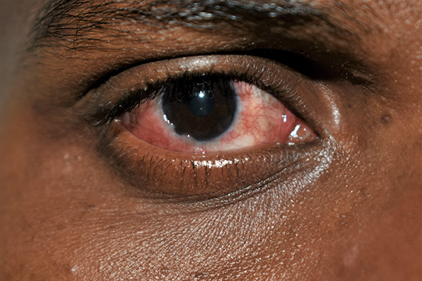 Conjunctivitis